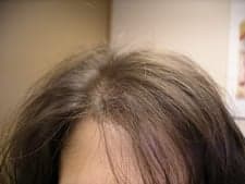 Hair Loss Control Clinic - hair transplant in Metairie, LA