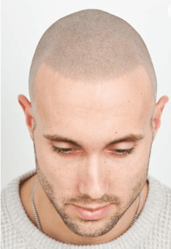 The Skin Studio - hair transplant in St. Augustine, FL
