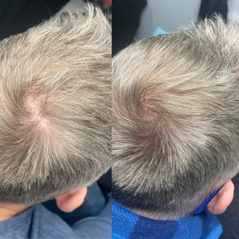 MedInk by Morgan - hair transplant in Rochester, NY