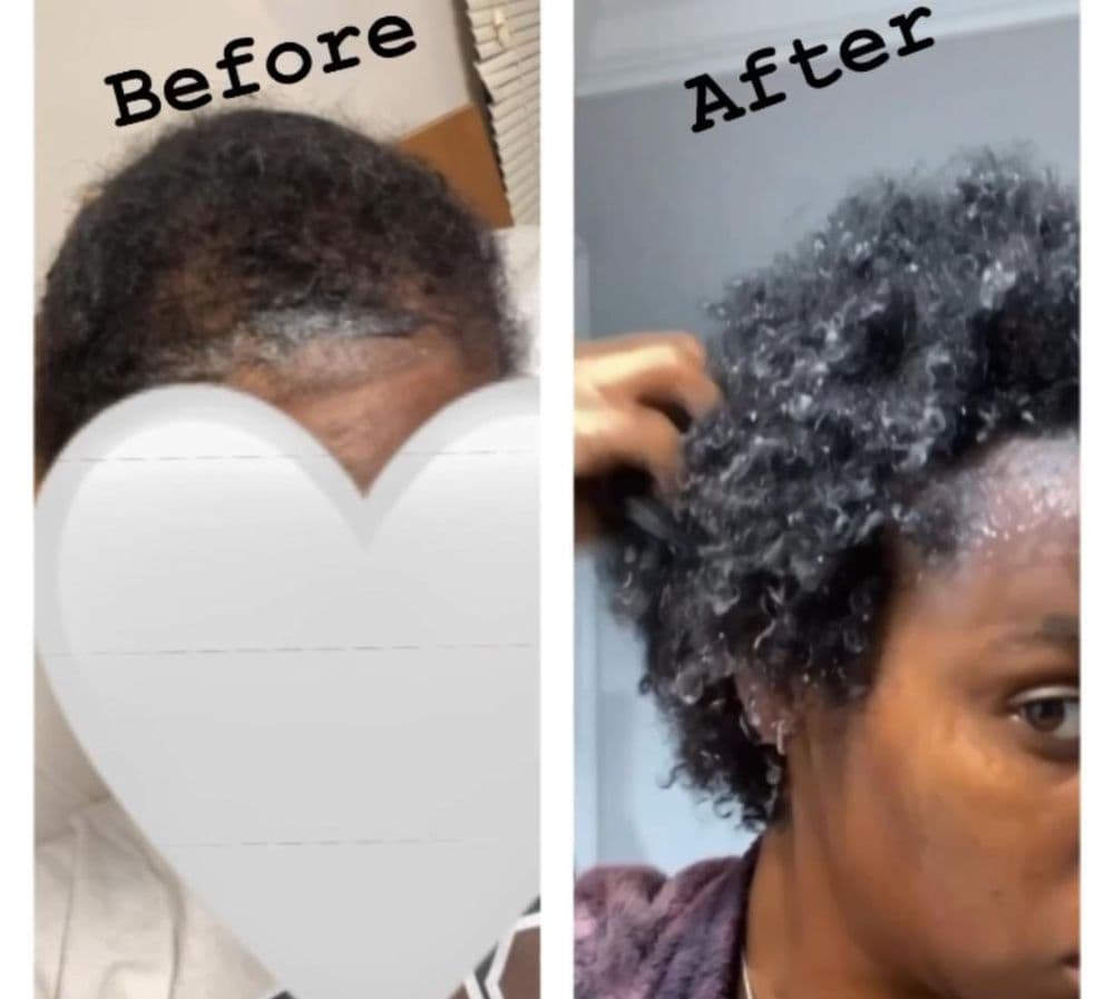Say My Hair - hair transplant in New Orleans, LA
