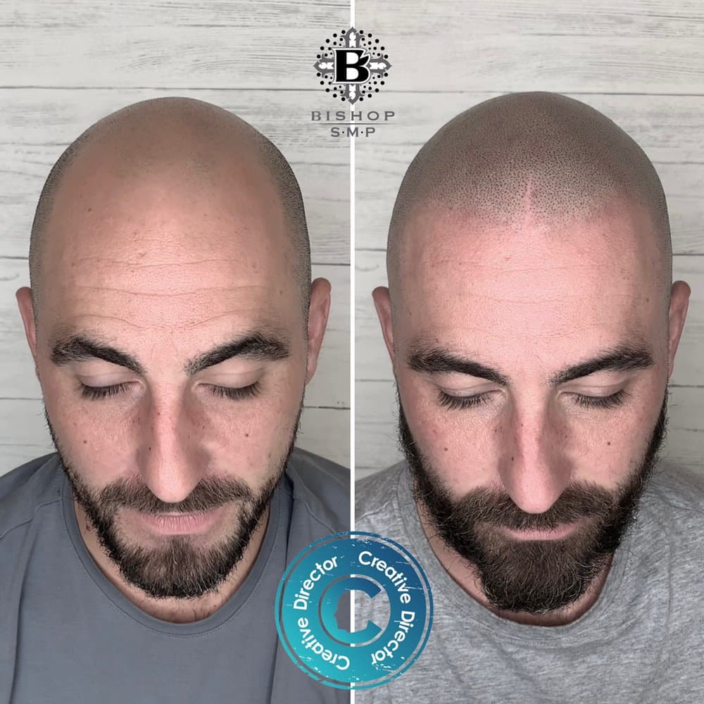 Creative Scalps - Arizona - hair transplant in Glendale, AZ