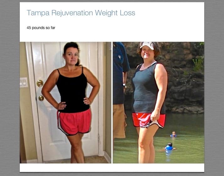 Tampa Rejuvenation - Westchase - hair transplant in Tampa, FL