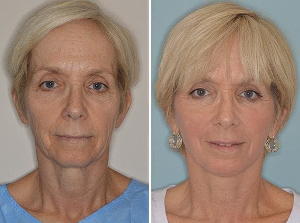 Anthony Bared, MD, FACS - hair transplant in South Miami, FL