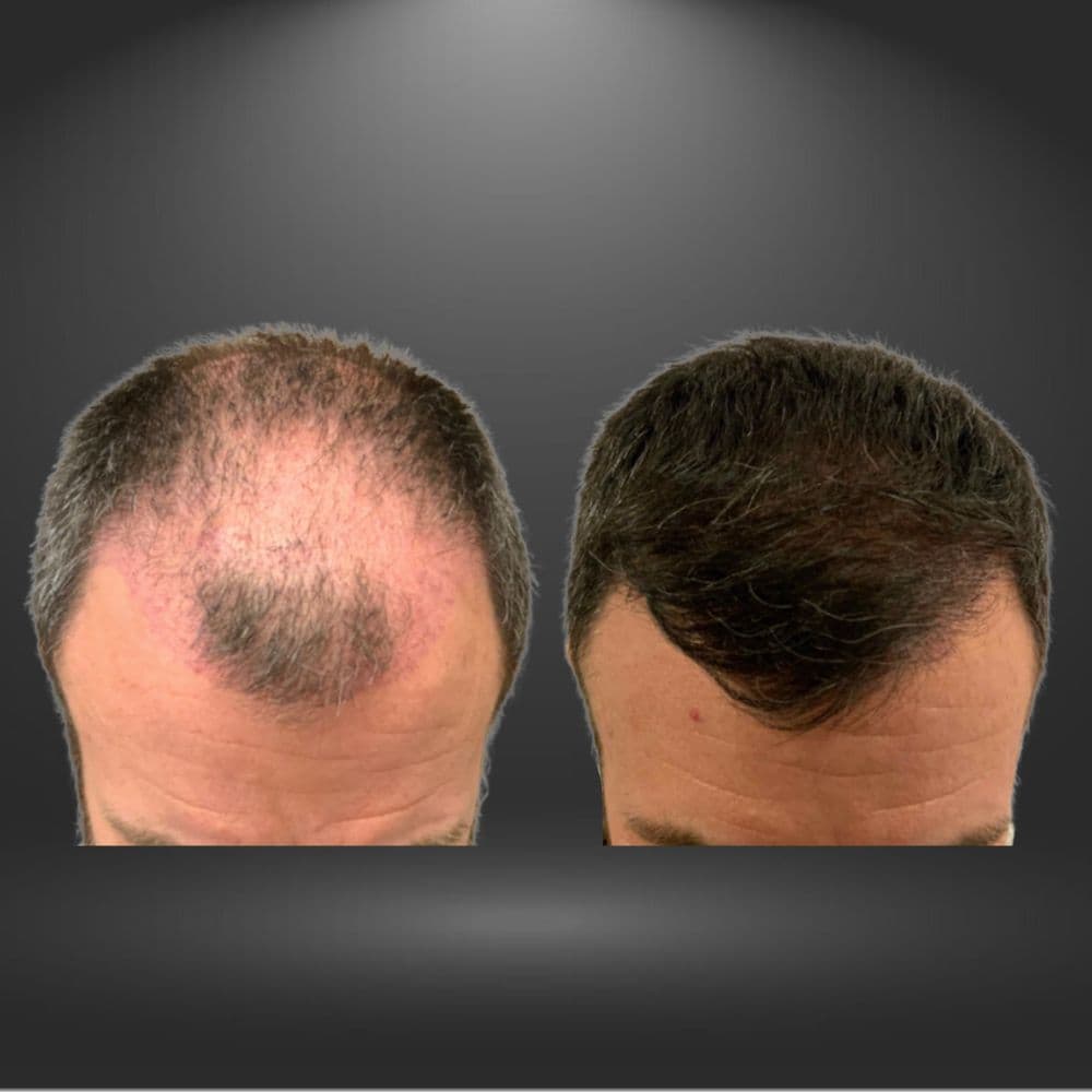 New England Center for Hair Restoration - hair transplant in Westwood, MA