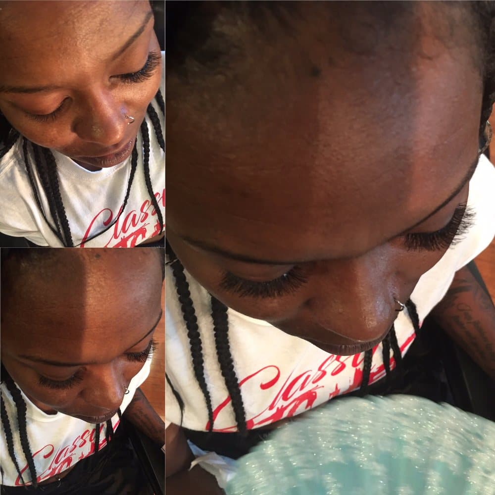 Turning_headz1 - hair transplant in Memphis, TN