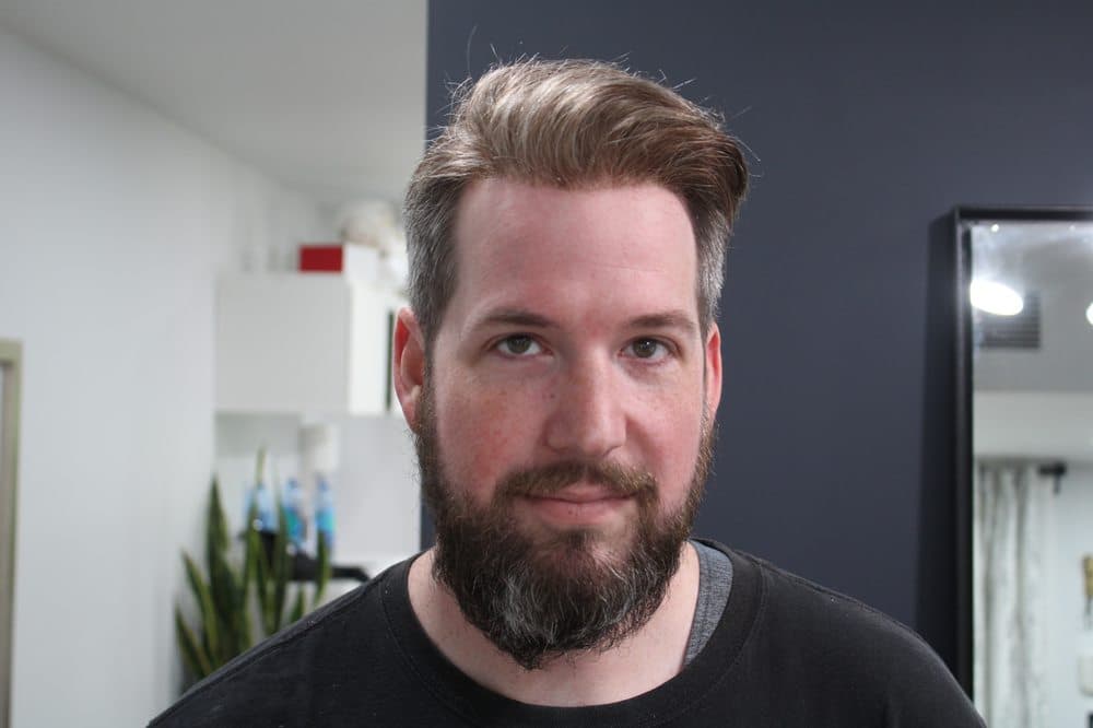 Savant Hair Replacement - hair transplant in Los Angeles, CA