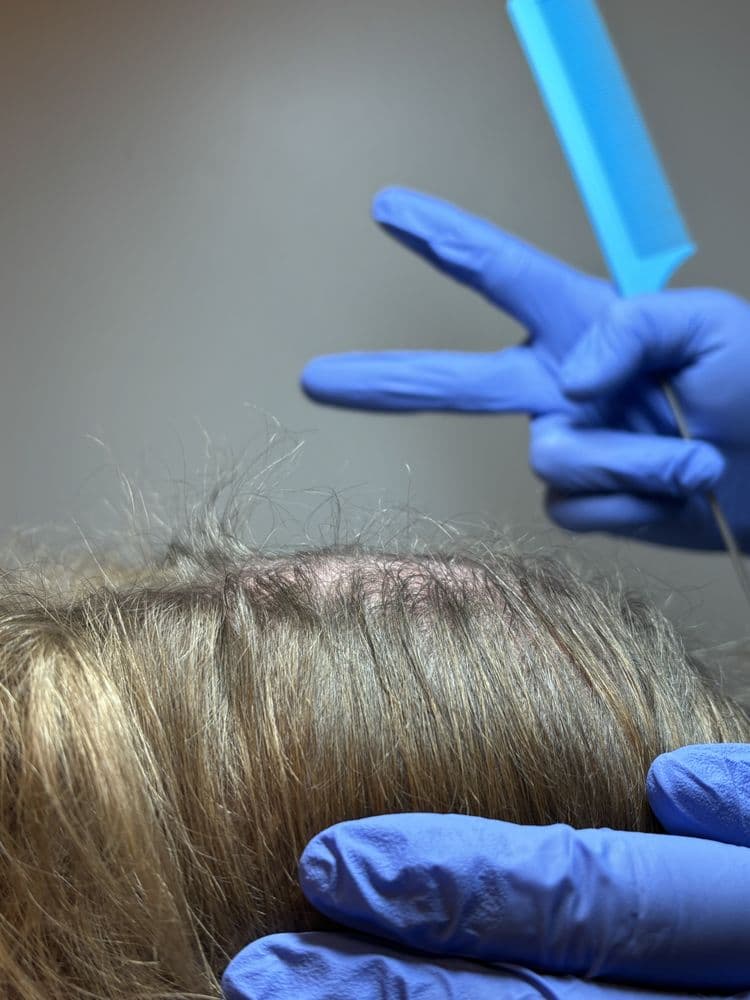 CK Hair Solution - hair transplant in St. Augustine, FL