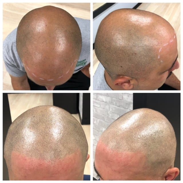 Scalp New England - hair transplant in Peabody, MA