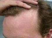 Physician's Hair Institute - hair transplant in Tucson, AZ