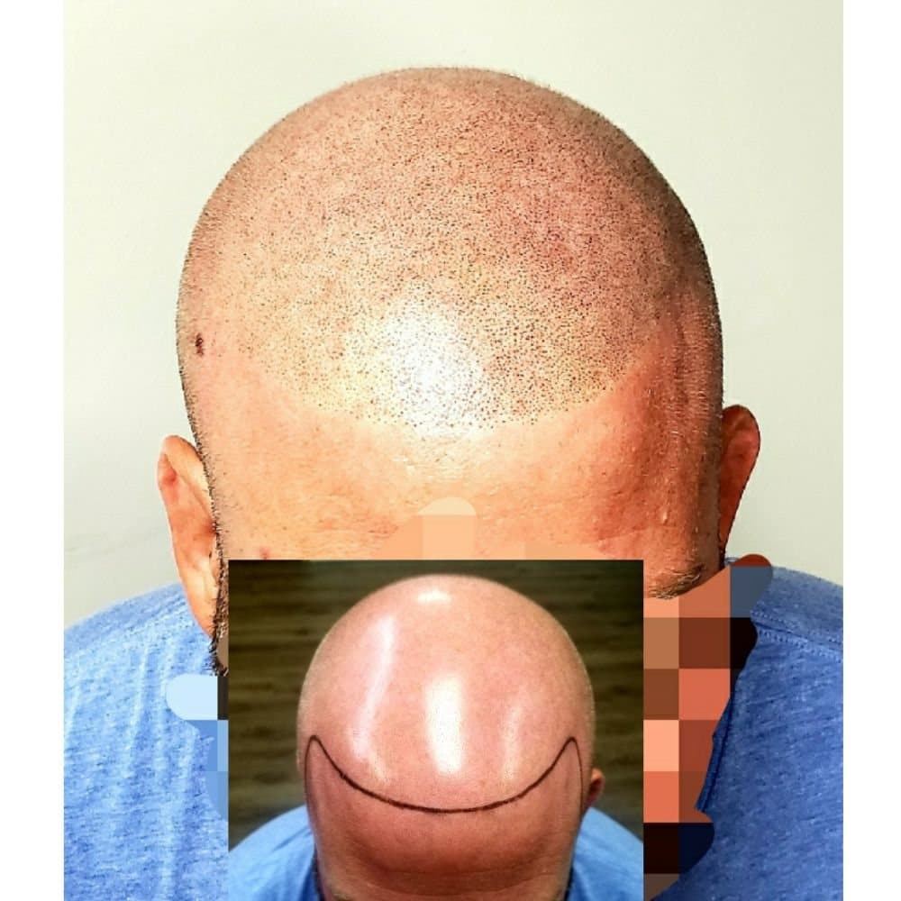 New Level Aesthetics - hair transplant in Charlotte, NC