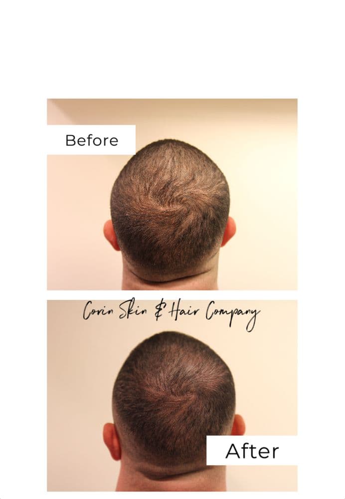 Corin Skin & Hair - hair transplant in New York, NY