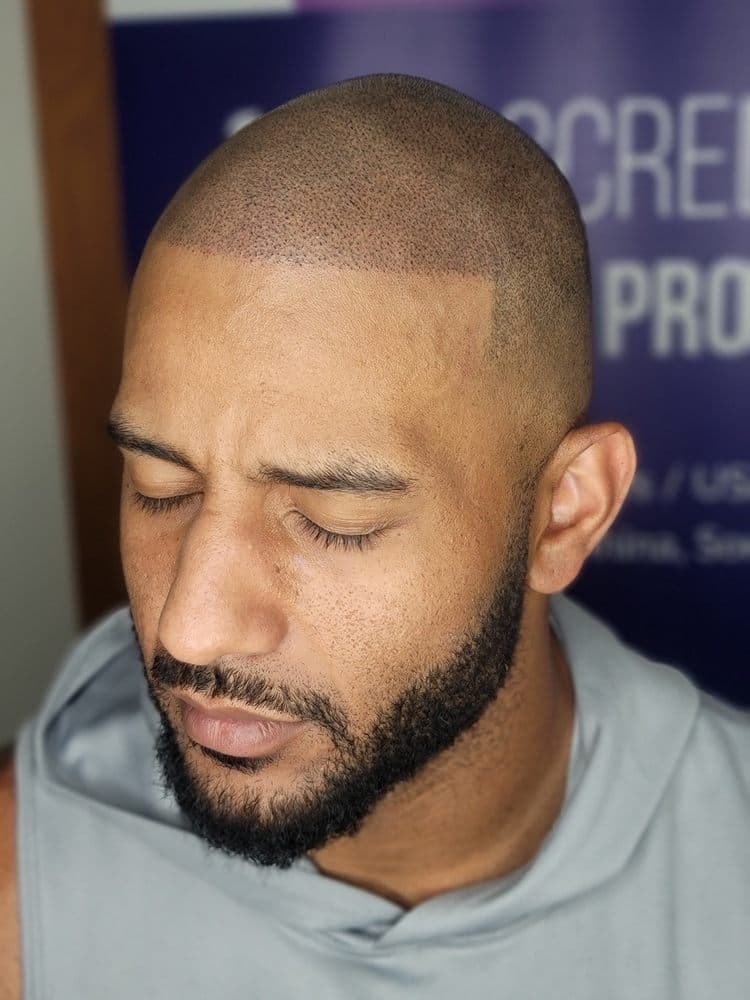 Scalp Artist International - hair transplant in Denver, CO