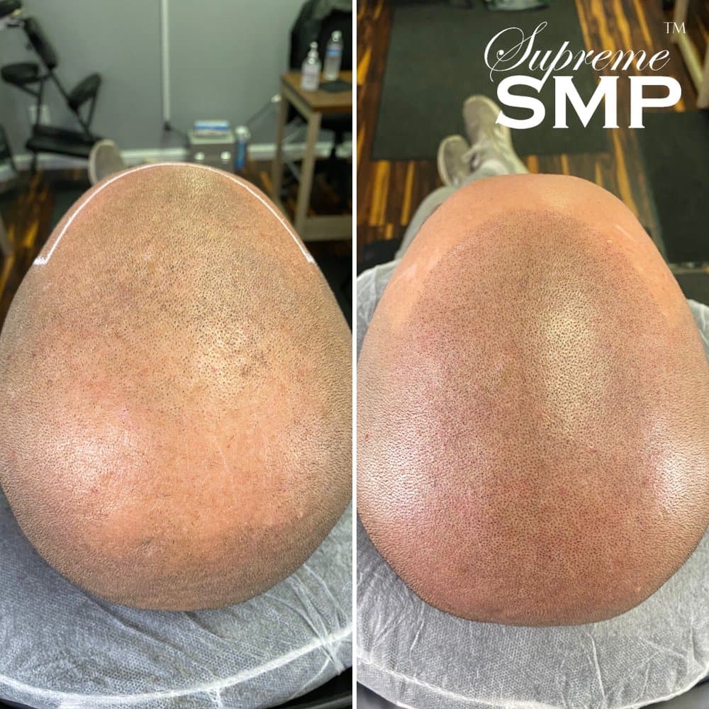 Supreme SMP - hair transplant in Wilmington, MA