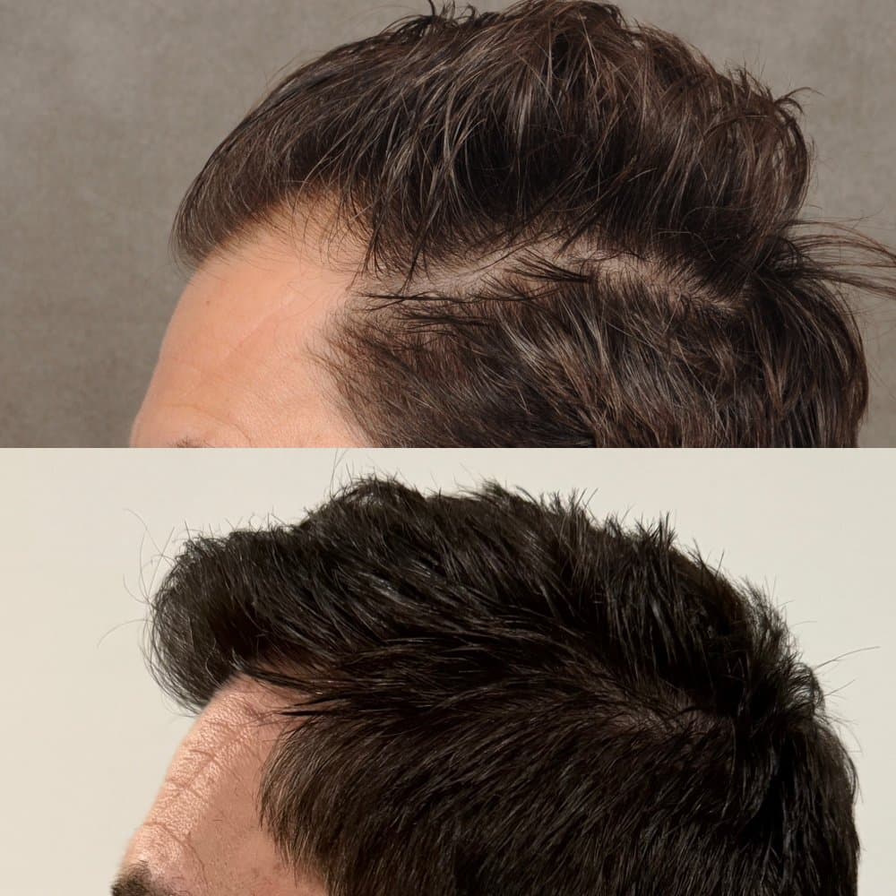 Beverly Hills Hair Group - hair transplant in Beverly Hills, CA