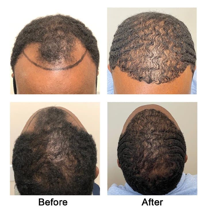 AZ Hair Restoration - hair transplant in Apex, NC
