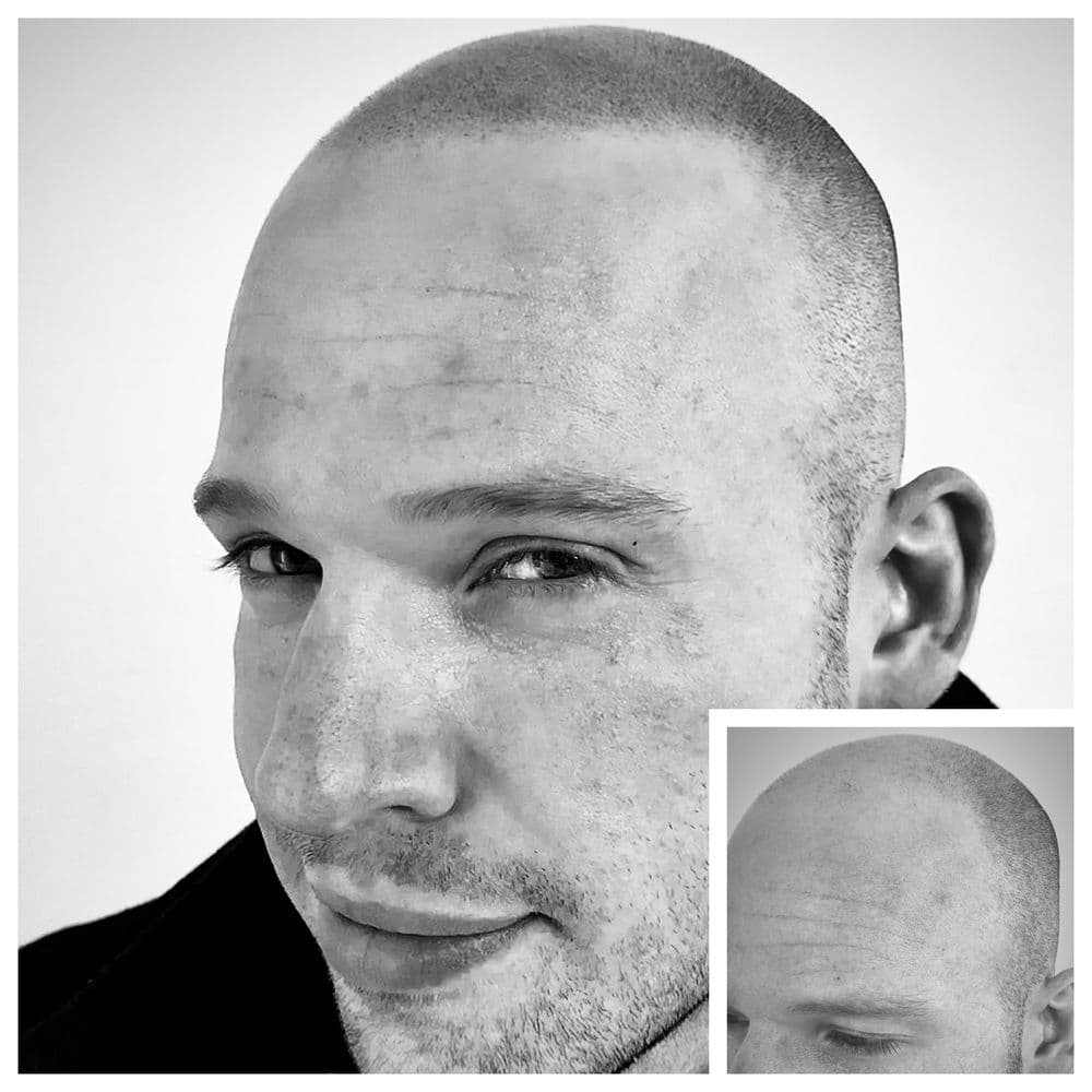 Precision Scalp Micropigmentation - hair transplant in Oakbrook Terrace, IL