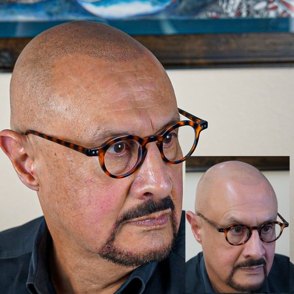 Magazine Cover Scalp Micropigmentation - hair transplant in Arlington, TX