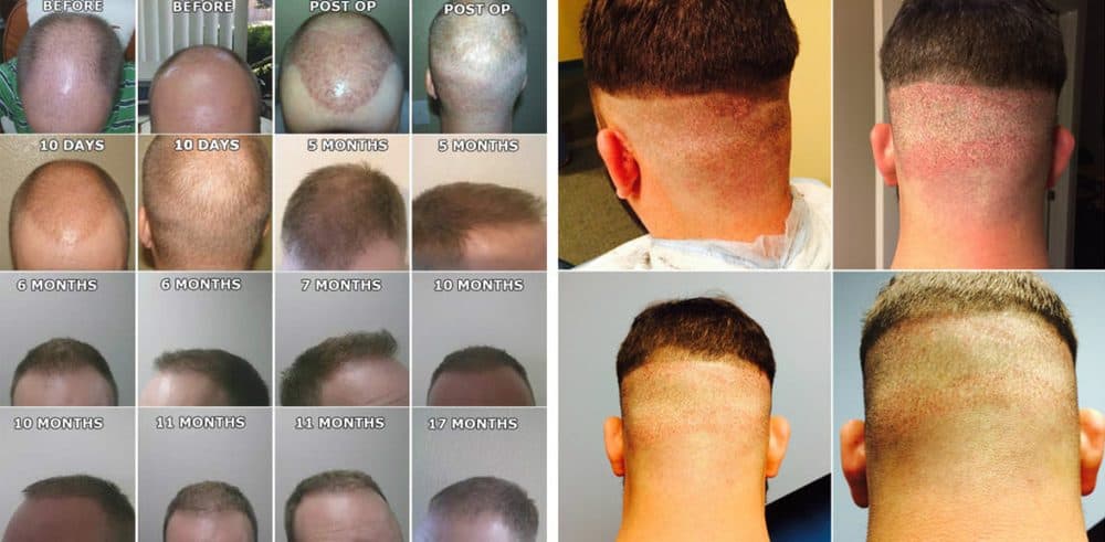 Hair Loss Center - hair transplant in Miami, FL