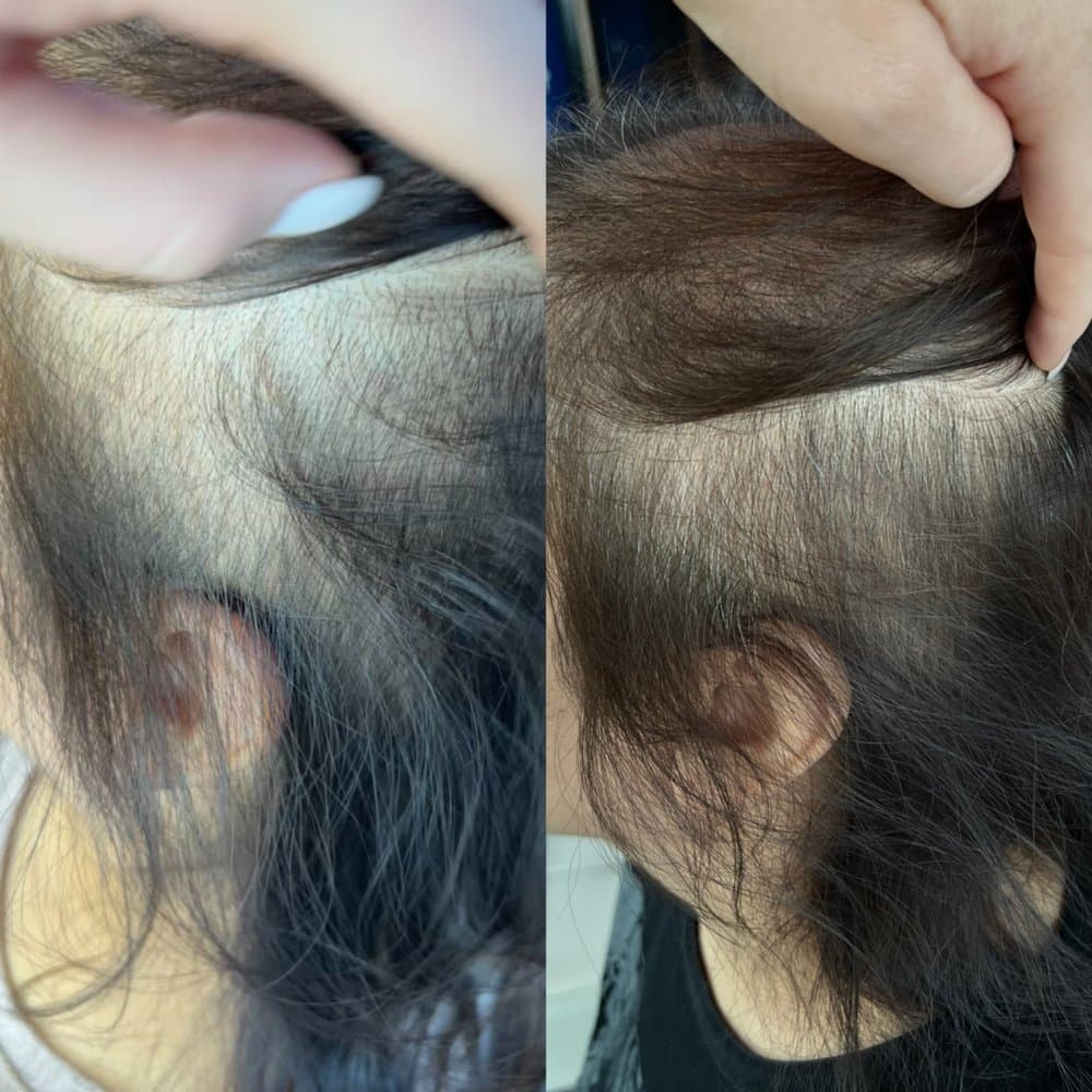 Athena Beauty - hair transplant in Austin, TX