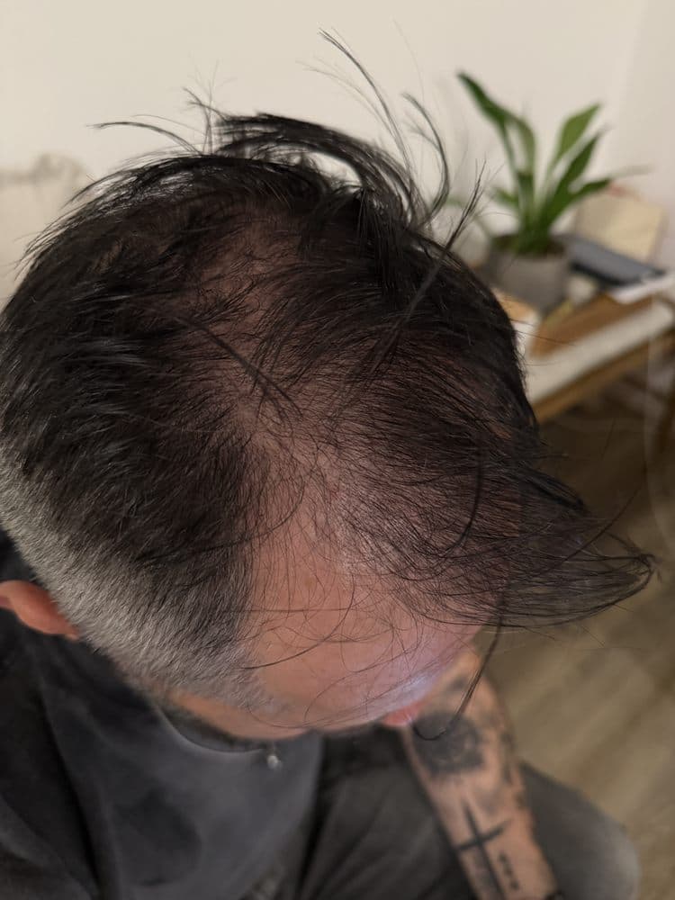 Skin Fix Camouflage - hair transplant in Scottsdale, AZ