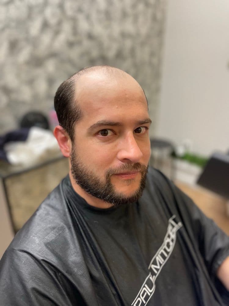 MD Hair Design - hair transplant in Los Angeles, CA