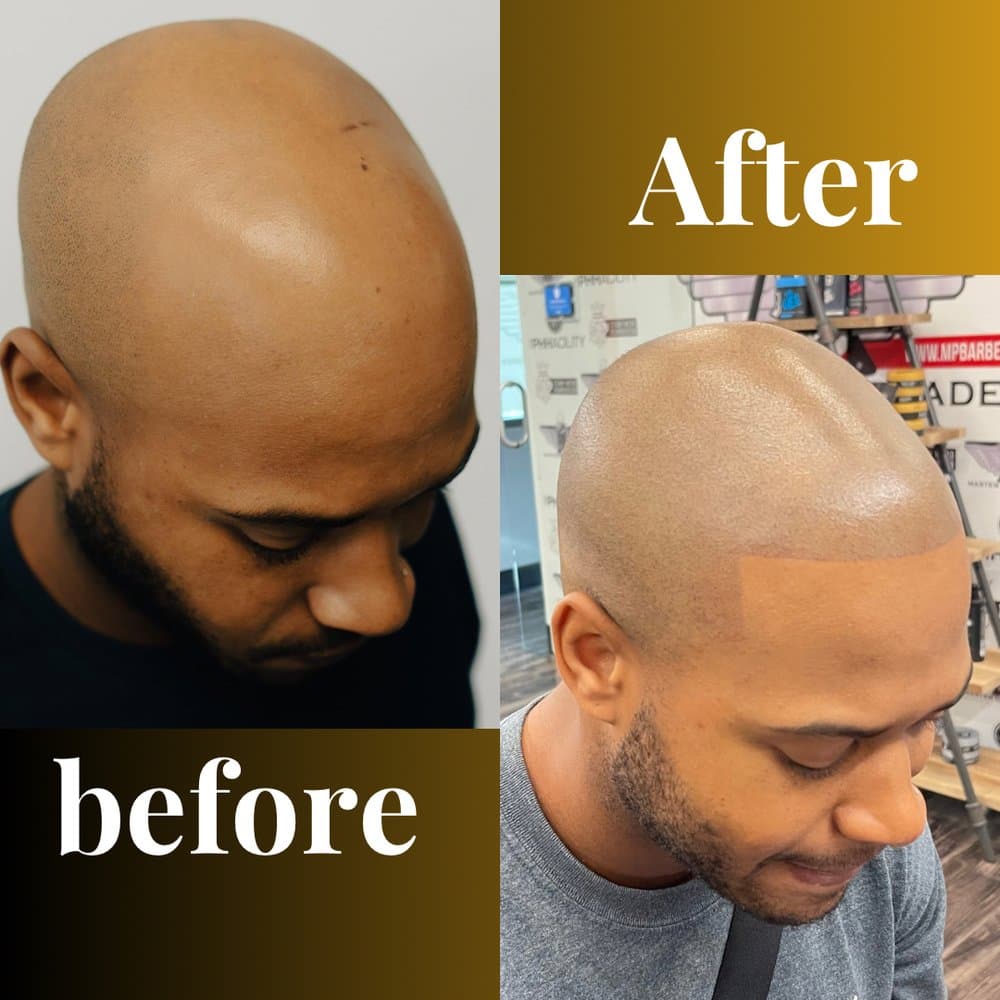 More Than A Hair Tattoo - hair transplant in Phoenix, AZ