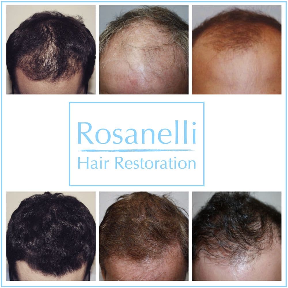 Tom Rosanelli, MD - hair transplant in Honolulu, HI
