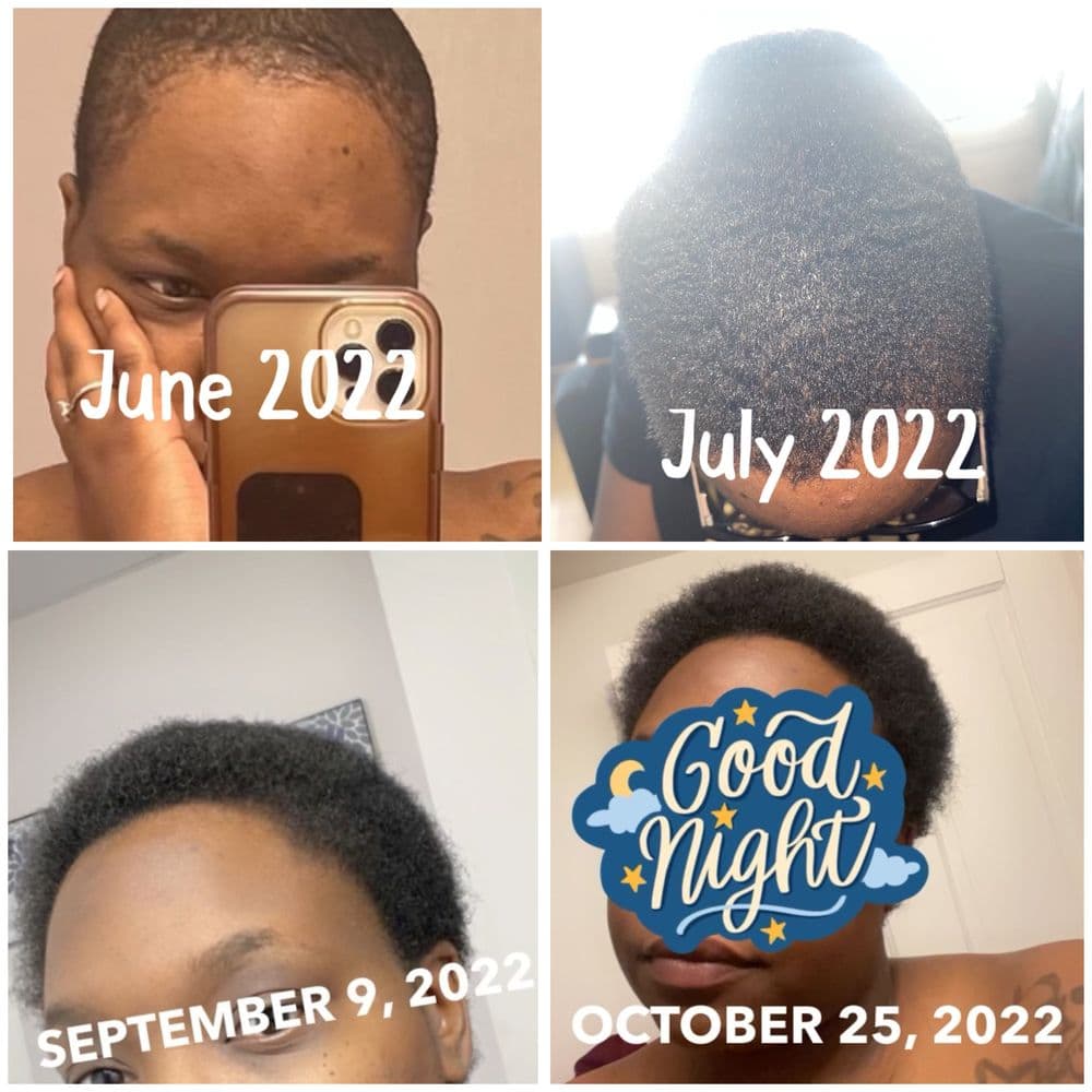 Angelic’s Beauty - hair transplant in Mequon, WI