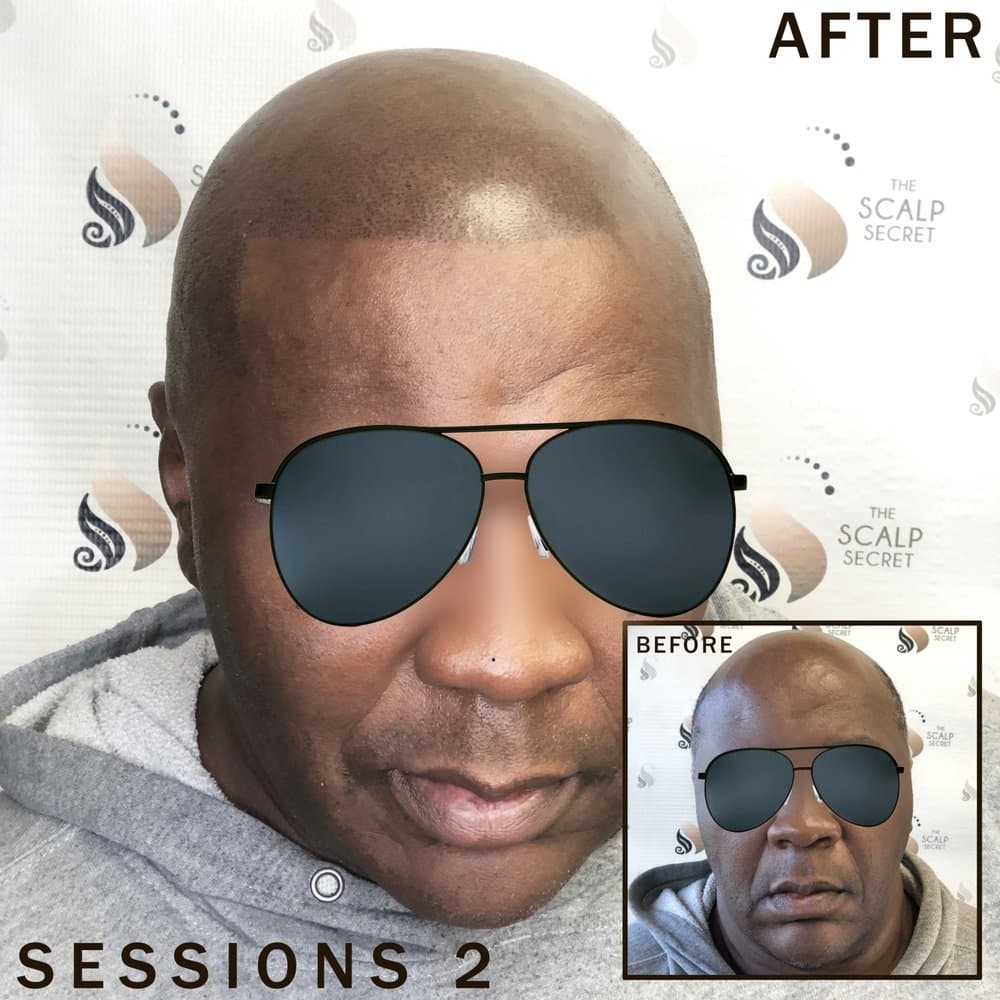 The Scalp Secret - hair transplant in Las Vegas, NV