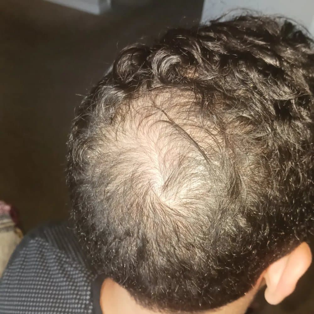 Micro Scalpp - hair transplant in Houston, TX