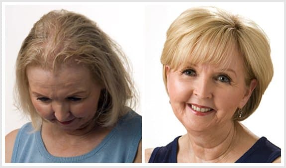 Headline Studio - hair transplant in Matthews, NC
