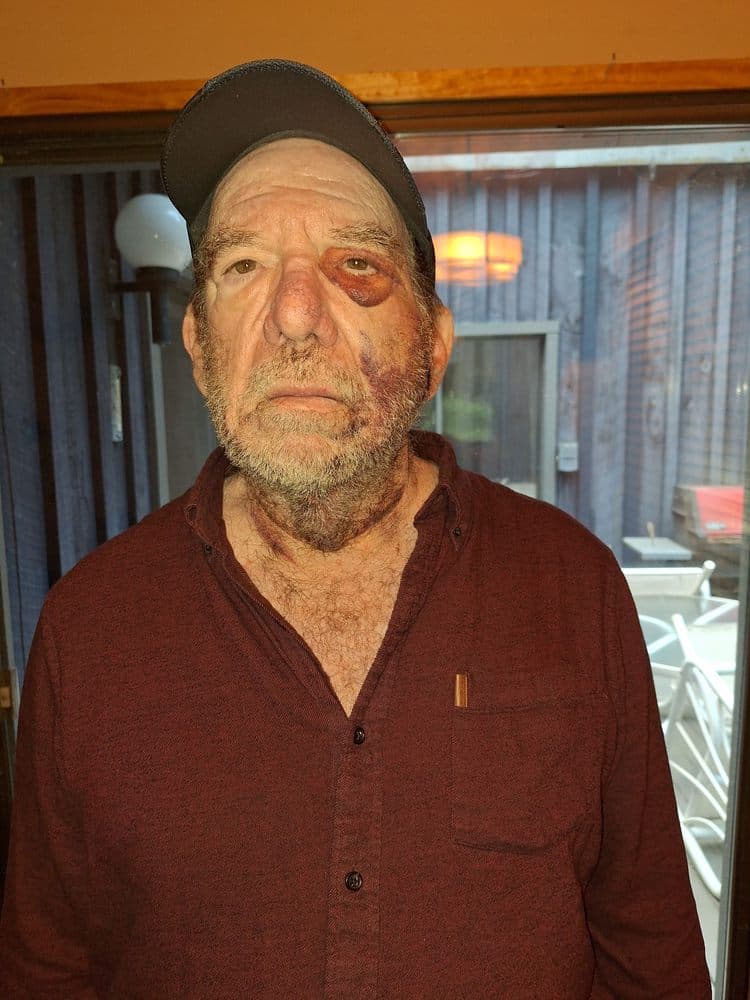 Heights Dermatology and Laser - hair transplant in Brooklyn, NY