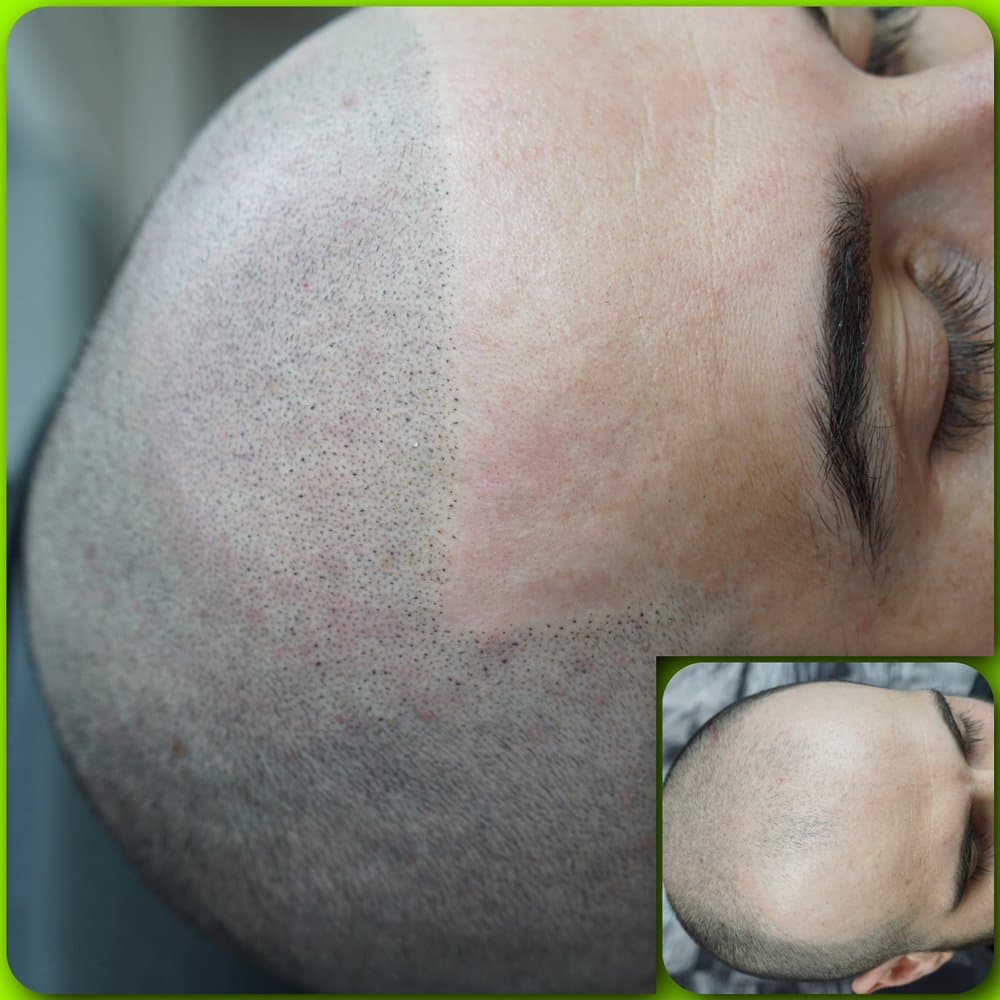 Everyday Power SMP - hair transplant in Colorado Springs, CO