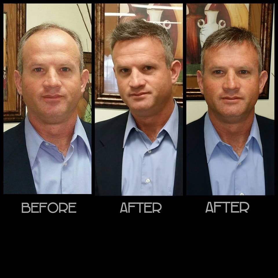 Argyle Hair Solutions - hair transplant in Bountiful, UT