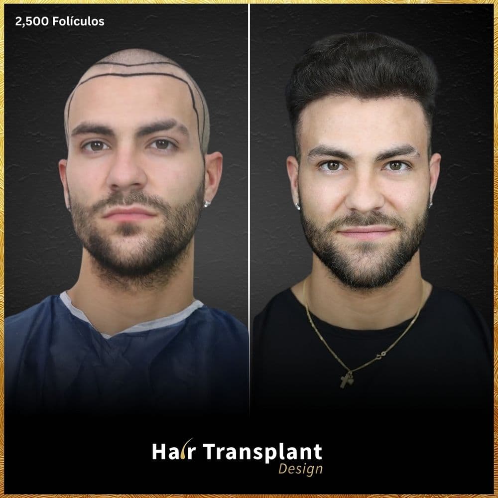 Hair Transplant Design - hair transplant in Tampa, FL