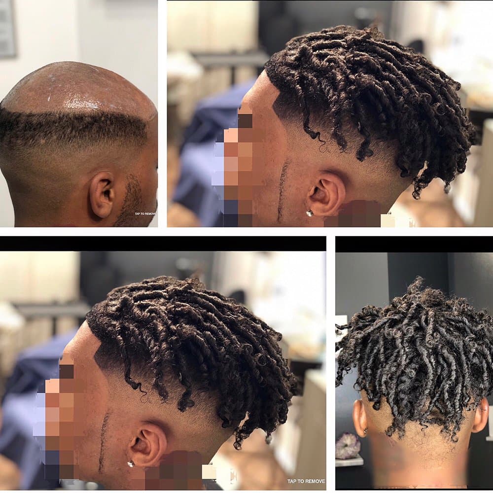 Units R' Us - hair transplant in Tampa, FL