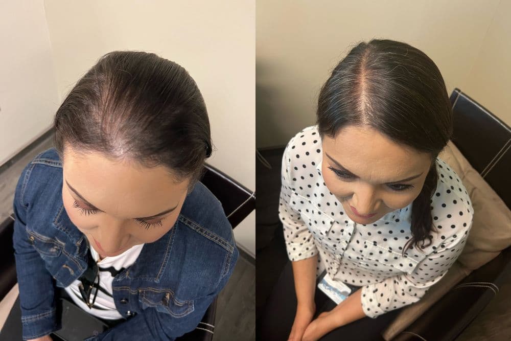 Regenesis Wellness - hair transplant in Millcreek, UT