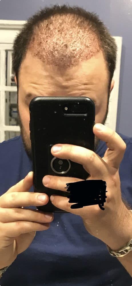 Best Hair Transplant - hair transplant in Redondo Beach, CA