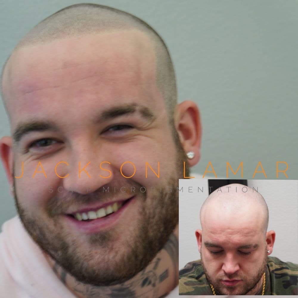 Jackson Lamar - hair transplant in Dallas, TX