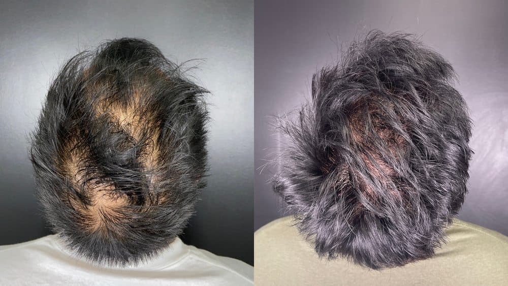 Hair Transplant Hawaii - hair transplant in Honolulu, HI