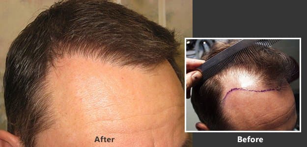 Timothy Carman, MD - La Jolla Hair Restoration - hair transplant in San Diego, CA