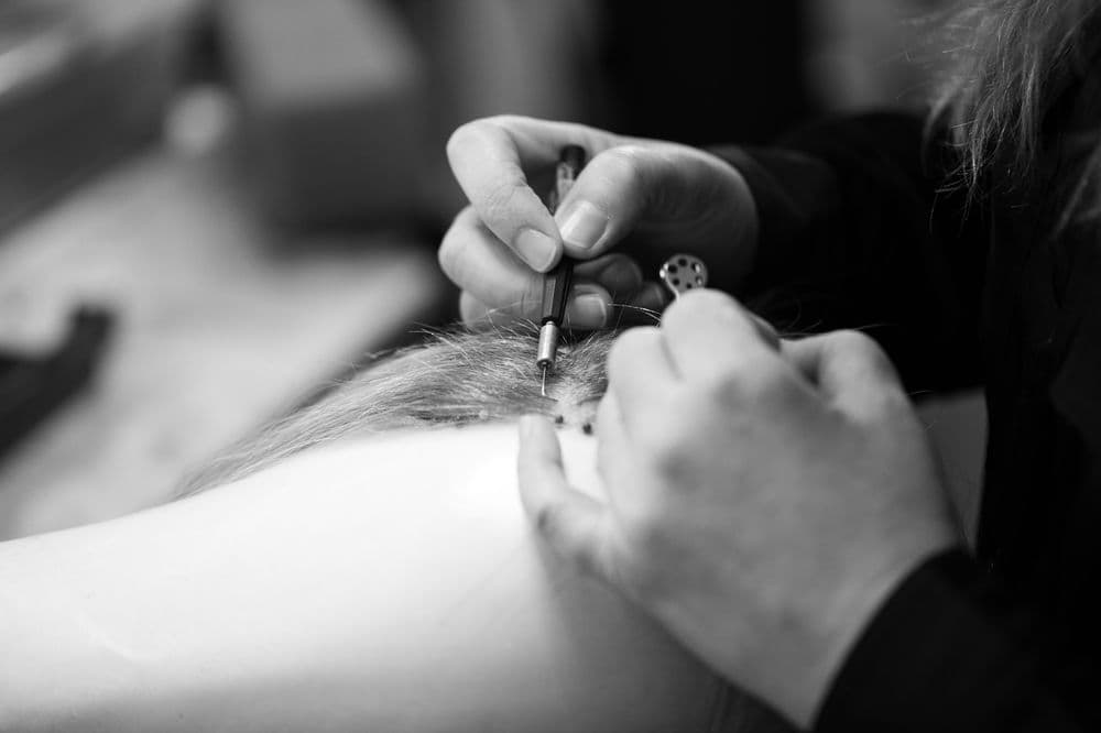 Merria Dearman - hair transplant in San Francisco, CA