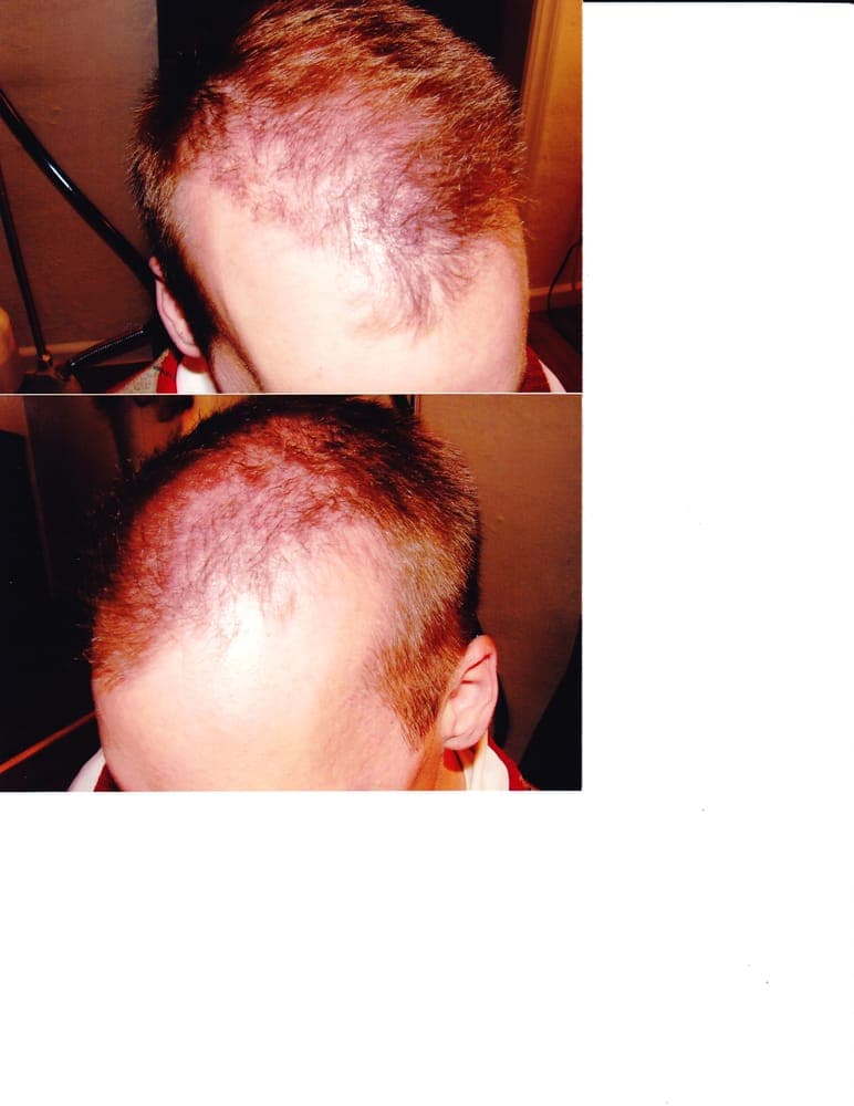 Hair Solutions - hair transplant in Sausalito, CA