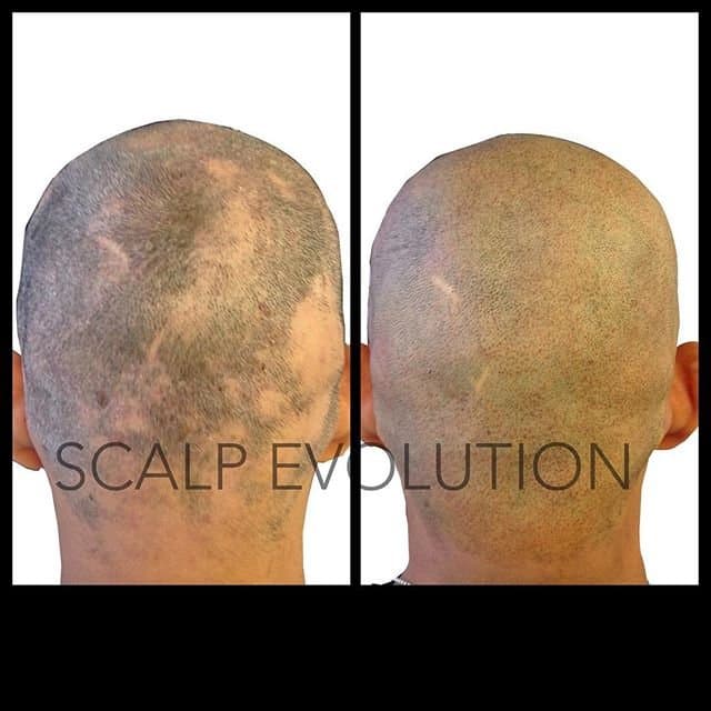 Scalp Evolution - hair transplant in Miami, FL