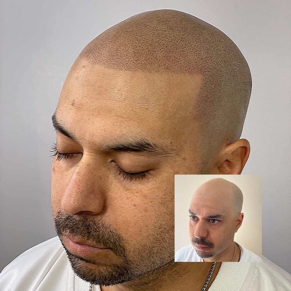 Shadow Smp - hair transplant in Mesa, AZ