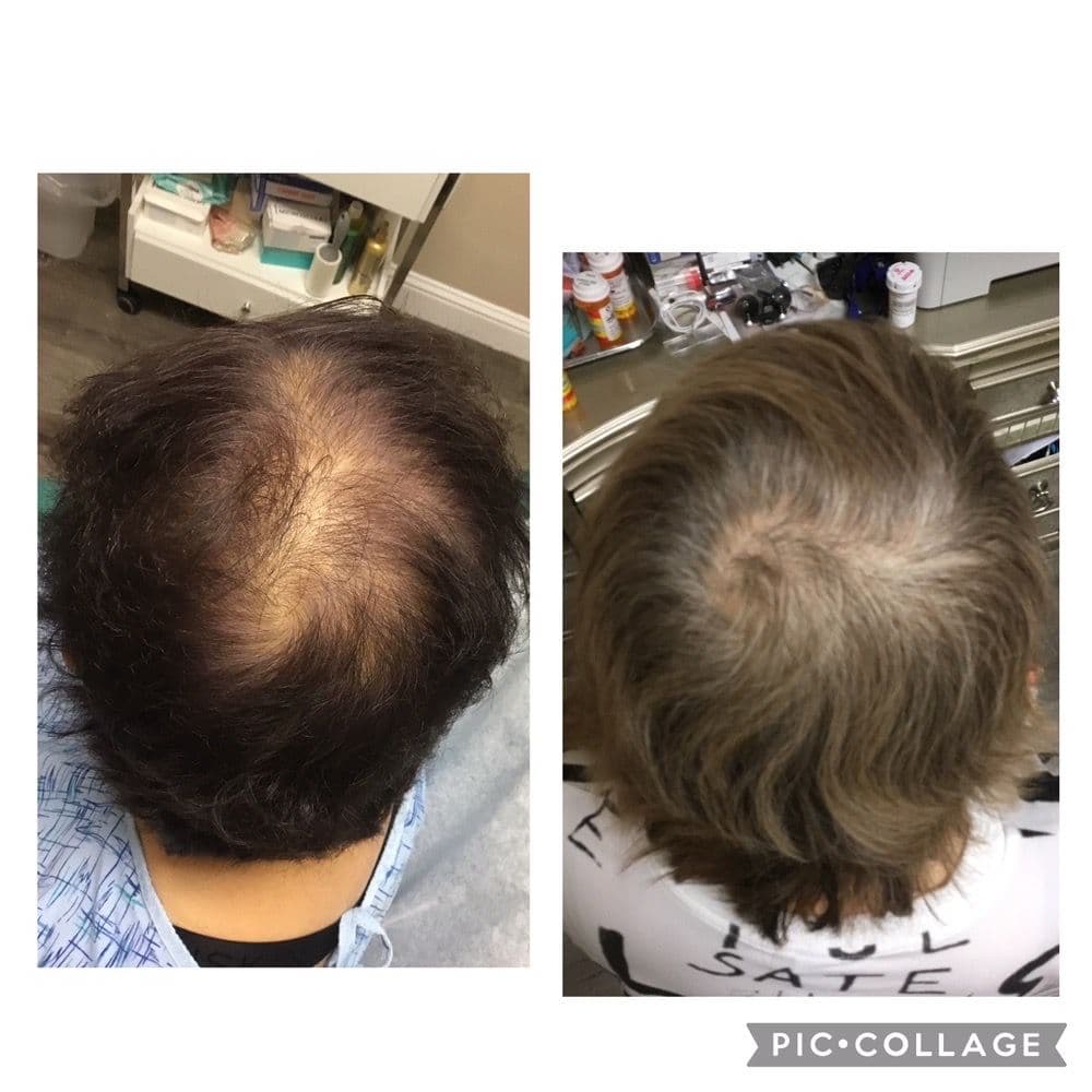 Hair Centers - hair transplant in Milpitas, CA