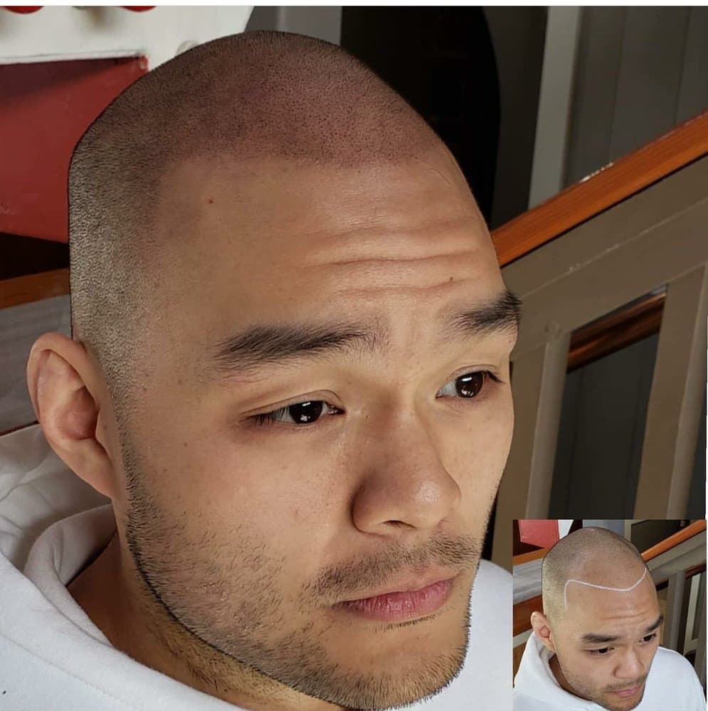 America Scalp Micro - hair transplant in Columbia, MD