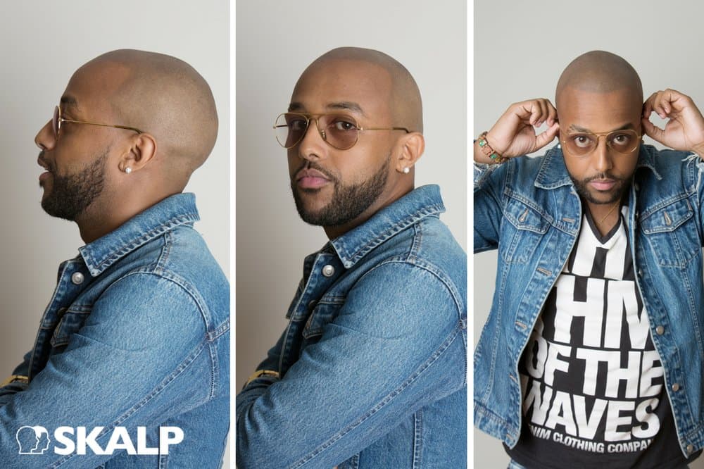 Skalp - New York - hair transplant in New York, NY