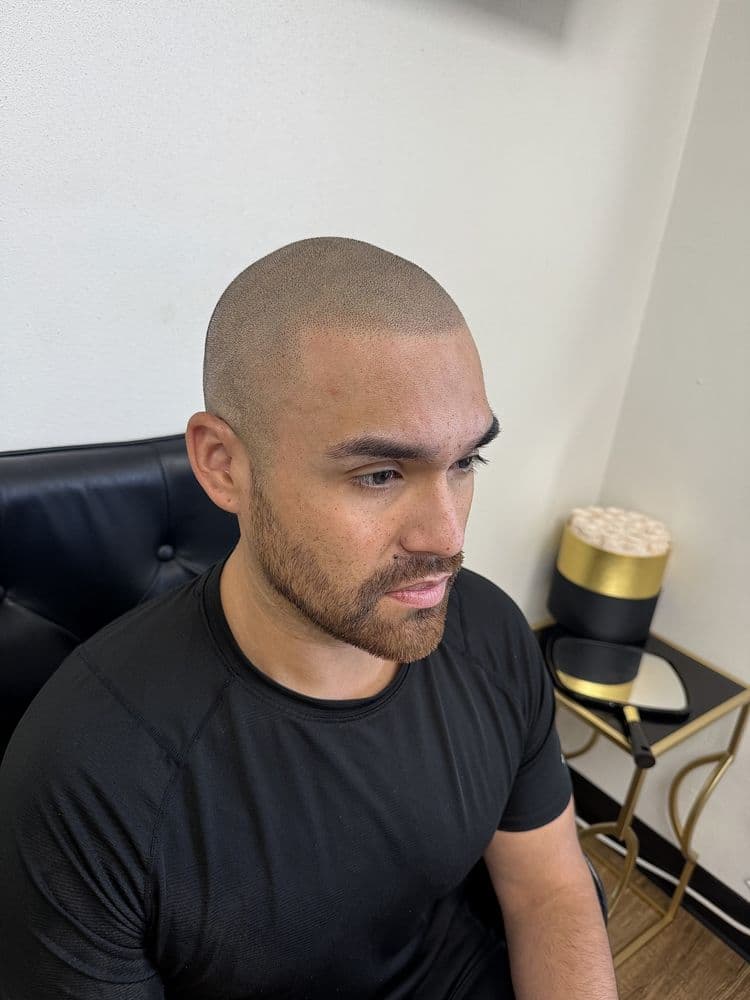 Ft Worth SMP - hair transplant in Houston, TX