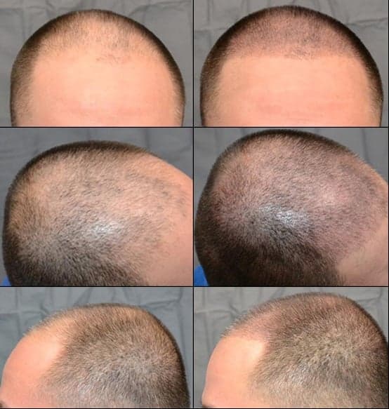 Evolve Hair Clinic - hair transplant in Eagan, MN